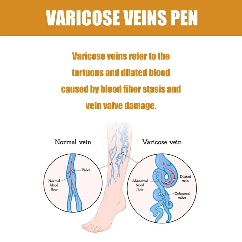 Varicose Veins Pen